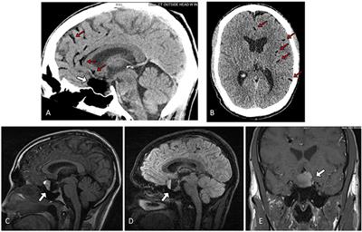 Ruptured Suprasellar Dermoid Cyst Treated With Lumbar Drain to Prevent Postoperative Hydrocephalus: Case Report and Focused Review of Literature